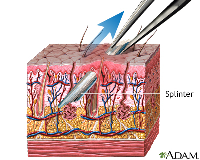 Wood Splinter In Eye