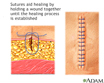 What is the meaning of gaping puncture wound? - Question about