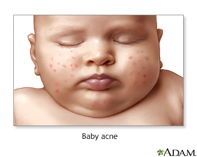 Baby acne - Illustration Thumbnail
              