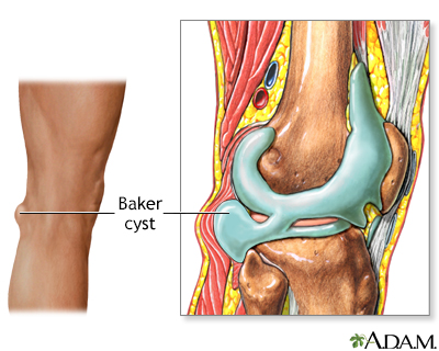 Baker cyst