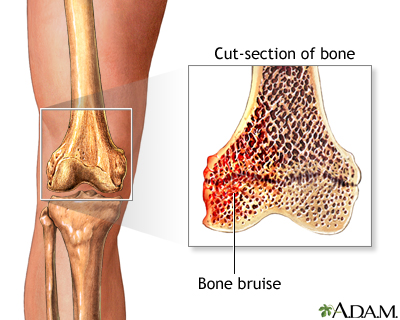 Bone bruise - Illustration Thumbnail
                      