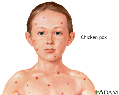 chicken pox on babies