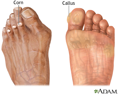 Corns and calluses - Illustration Thumbnail
                      