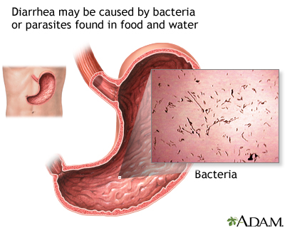 diarrhea causes in women