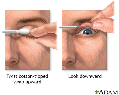 Eyelid eversion - Illustration Thumbnail
              