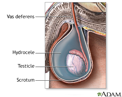 Hydrocele - Illustration Thumbnail
                      