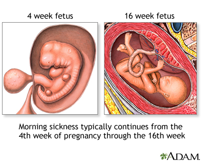 Morning sickness - Illustration Thumbnail
              