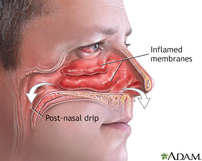 nasal congestion runny nose