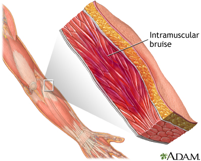 Muscle bruise - Illustration Thumbnail
              