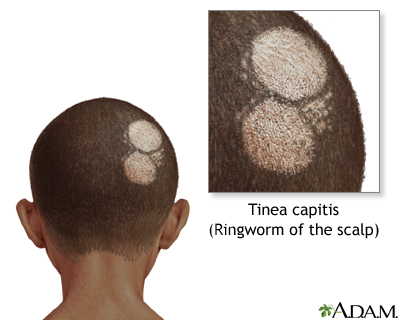 Ringworm of the scalp - Illustration Thumbnail
              