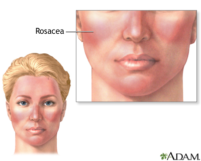 Rosacea - Illustration Thumbnail
                      