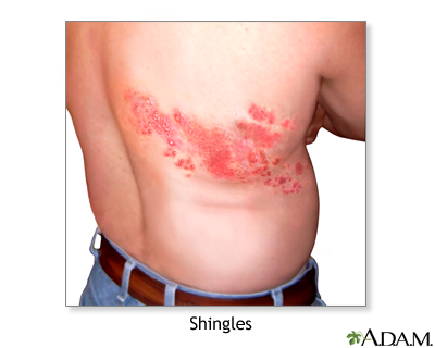 I'm 31 and I got diagnosed with Shingles yesterday. The pain is