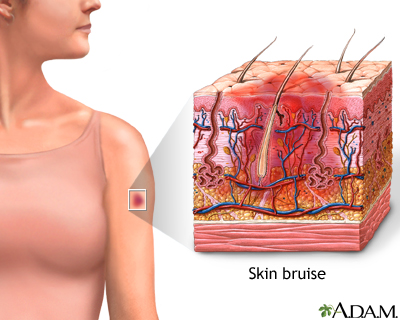 bruise diagram