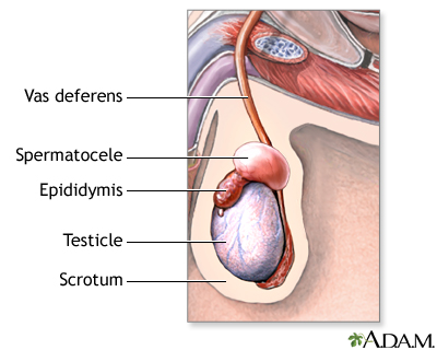 Scrotal masses Information Mount Sinai New York