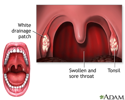 After blowjob throat sore Sore throat