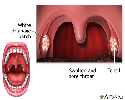 White blisters deals in throat