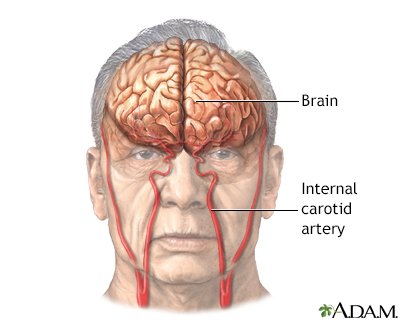 carotid artery brain prognosis