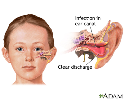 View Preauricular Pit Infection Drainage Images