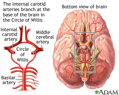 Stroke - Part 2