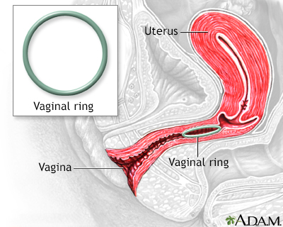 Cryosurgery of Cervix