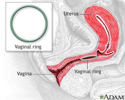 A New Contraceptive Ring