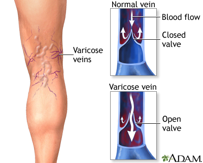 Varicose veins Information