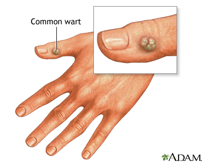 common warts on feet