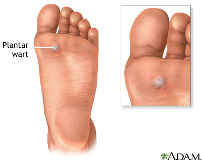 Plantar wart - Illustration Thumbnail
              