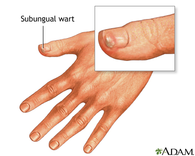 warts on fingers removal