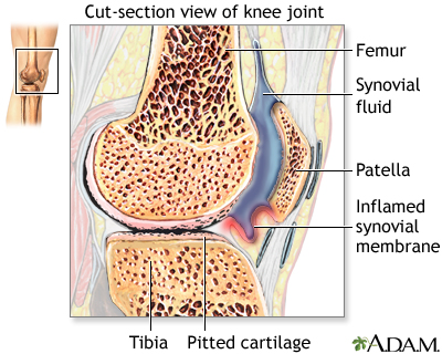 Rheumatoid arthritis - Illustration Thumbnail