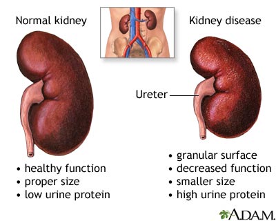 Diabetic nephropathy - Illustration Thumbnail							