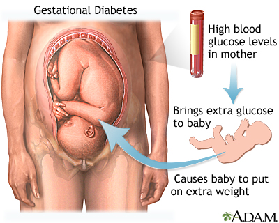 Gestational diabetes - Illustration Thumbnail              
