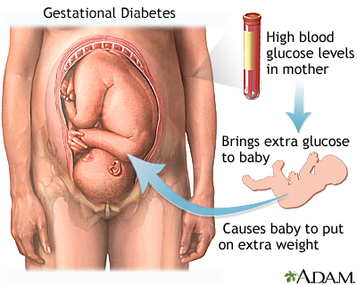 Gestational diabetes - Illustration Thumbnail
              