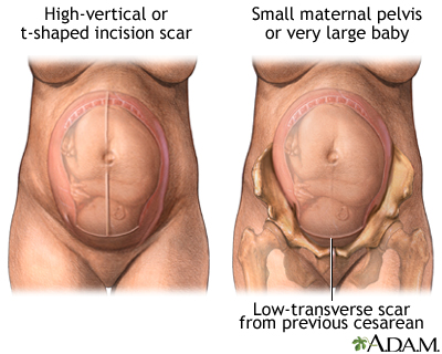Vaginal Birth after C-Section