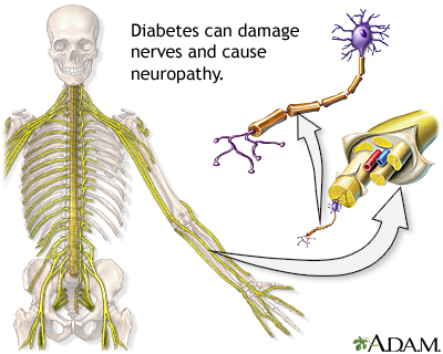 Diabetes and nerve damage - Illustration Thumbnail							