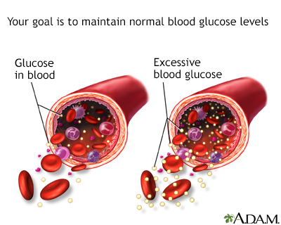 Type 2 diabetes Information Mount Sinai New York