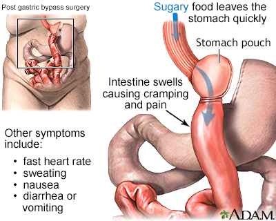 Dumping syndrome