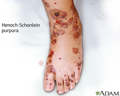 henoch schonlein purpura in adults