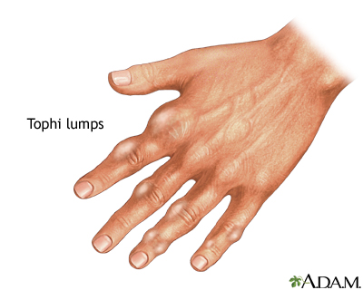 Tophi gout in hand - Illustration Thumbnail
              