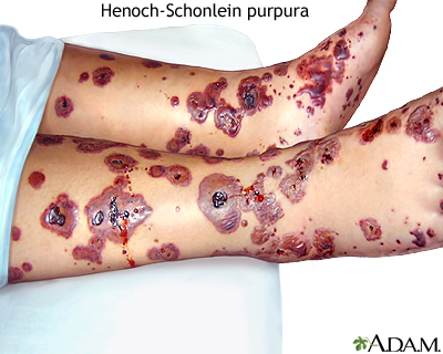 Henoch-Schonlein purpura - Illustration Thumbnail
                      