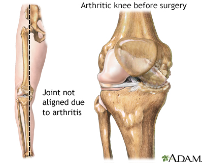 Knee misaligned due to arthritis - Illustration Thumbnail
                      