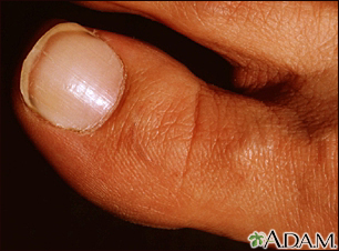 Nail Abnormalities Information Mount Sinai New York