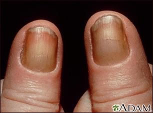 What Explains This Man's Nail Discoloration? | Consultant360