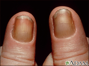 Yellow and thickened toes' nails with lymphedema