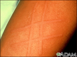 Dermatographism on the arm - Illustration Thumbnail
                      