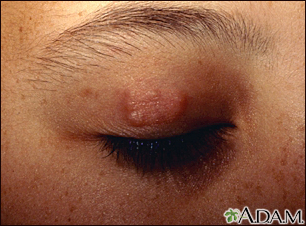 Granuloma annulare on the eyelid - Illustration Thumbnail
              