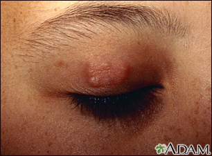 Granuloma annulare on the eyelid - Illustration Thumbnail							