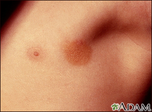 Urticaria pigmentosa Information