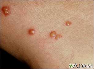 skin blisters causes