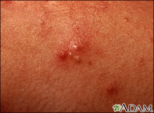 Acne - close-up of pustular lesions